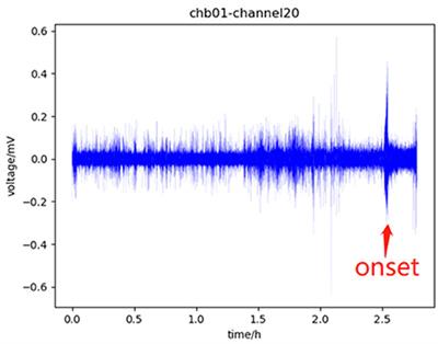 A multi-frame network model for predicting seizure based on sEEG and iEEG data